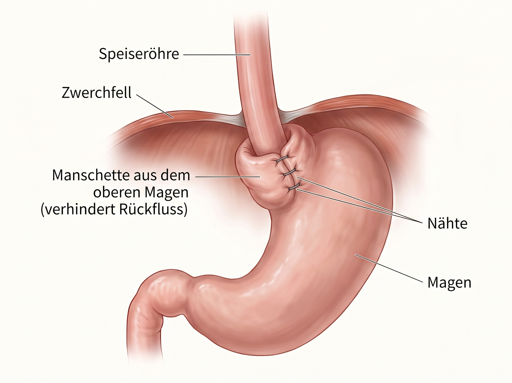 Fundoplicatio beim Kind: oberer Magen als Manschette um die untere Speiseröhre gelegt, gegen Reflux