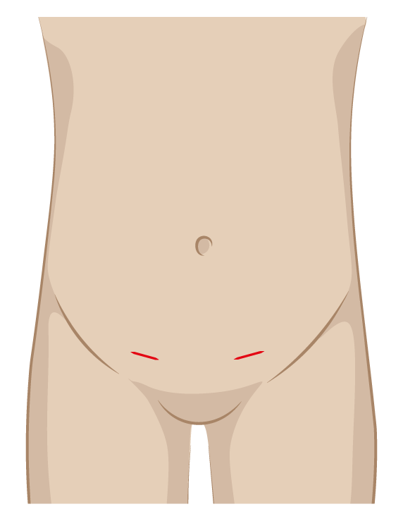 Schemazeichnung eines Kinderbauchs mit zwei kleinen Schnitten in beiden Leistenfalten bei offener Leistenbruch-Operation (Herniotomie)